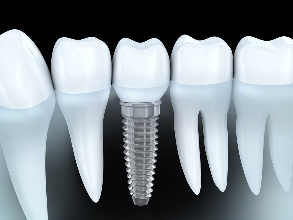 3d image of a tooth implant